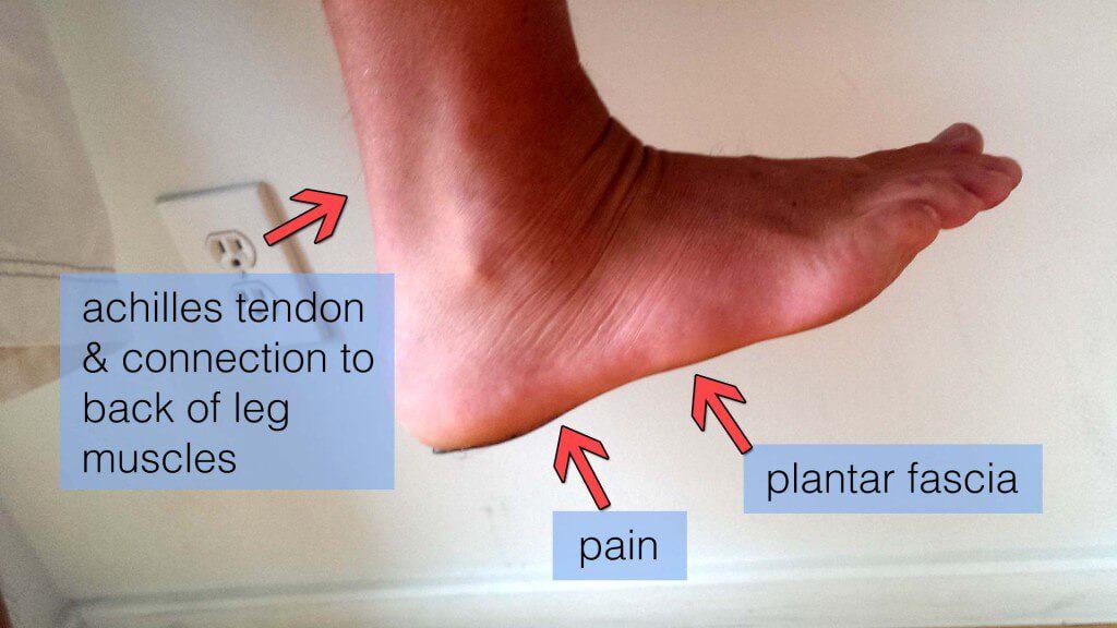 diagram of plantar fasciitis