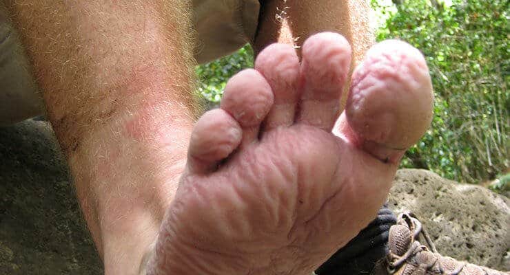 wet feet blisters