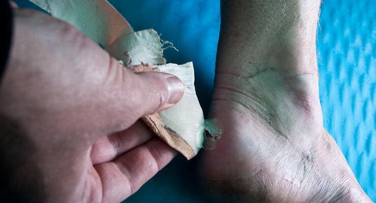 how to prevent blisters heel blister
