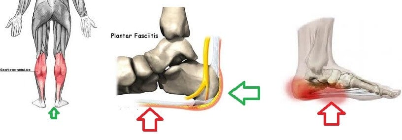 Plantar Fasciiits3